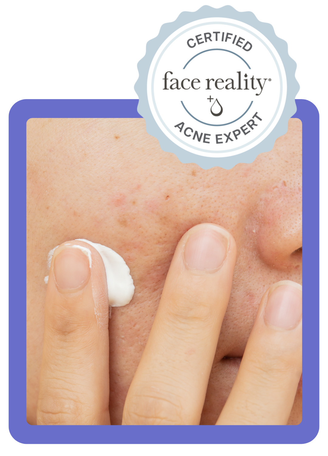 Wyckoff Acne Expert